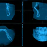 CBCT co to? Obraz pokazuje trójwymiarowe skanowanie szczęki i żuchwy, ukazujące zęby i kości w przekrojach.