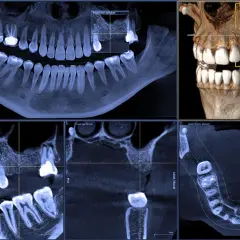 Tomografia CBCT prezentuje obraz zębów i szczęki w przekrojach: panoramicznym, osiowym, strzałkowym i poprzecznym.