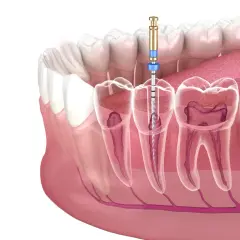 Jak bezpiecznie usunąć ząb? Kiedy dentysta, a kiedy domowe sposoby?