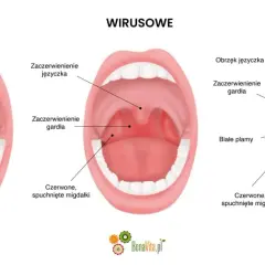 Porównanie gardła: normalne, wirusowe (zaczerwienienie, obrzęk języczka) i bakteryjne (białe plamy, afta w gardle).