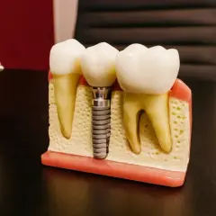 Model szczęki z zębami i mikroimplantem ortodontycznym. Pokazuje, jak implant zastępuje korzeń zęba.