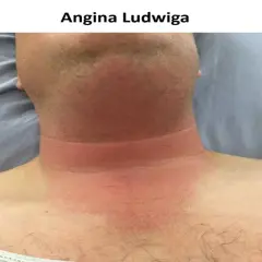 Szyja i klatka piersiowa pacjenta z widocznym zaczerwienieniem i obrzękiem, objawy wskazujące na anginę Ludwiga.