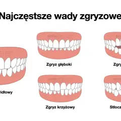 Ilustracja pokazuje różne wady zgryzu, w tym zgryz głęboki, otwarty, krzyżowy i stłoczenia zębów. Wady te mogą dotyczyć również tyłozgryzu u dziecka.