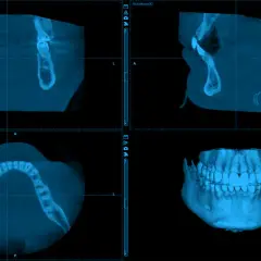 CBCT co to? Obraz pokazuje trójwymiarowe skanowanie szczęki i żuchwy, ukazujące zęby i kości w przekrojach.