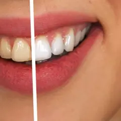 Wybielanie zębów u dentysty: Warto czy nie? Poznaj fakty!