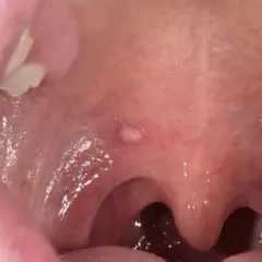 Objawy HPV w jamie ustnej: ciche sygnały, które ratują życie