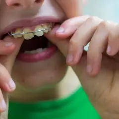 Dziecko z aparatem ortodontycznym typu twin block poprawia jego ułożenie.