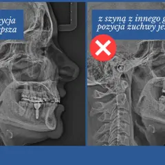 Rentgen żuchwy: po lewej bez szyny Michigan, pozycja lepsza. Po prawej z szyną, pozycja gorsza.