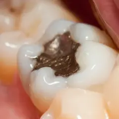 Widok zęba z widoczną, ciemną, metaliczną plombą, otoczoną białymi zębami i różowymi tkankami jamy ustnej.