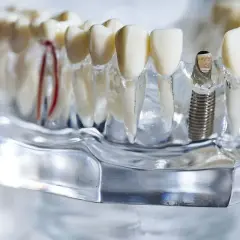 Model szczęki z implantem i dużymi zębami. Widać czerwone naczynia krwionośne.