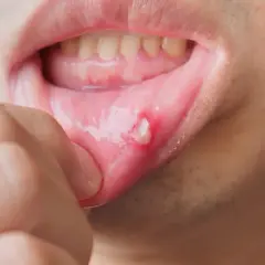 Masz opryszczkę? Dentysta odmówi! Co robić i kiedy iść?