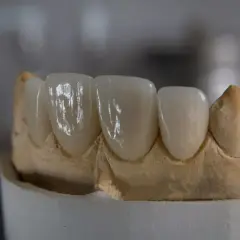 Model szczęki z porcelanowymi koronami, gotowymi do odbudowy zęba.