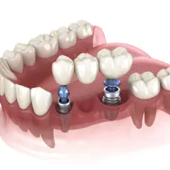 Koszt implantu zęba w Polsce: Pełna cena i co wpływa na nią?