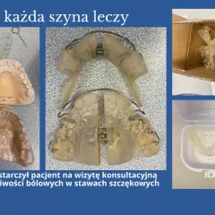 Szyny na zęby, modele szczęk i pudełka na ochraniacze. Pacjent przyniósł je z powodu bólu, co pokazuje, że bruksizm co to za problem, wymaga właściwego leczenia.