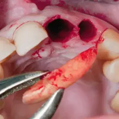 Palenie po dentyście: Suchy zębodół, implanty. Jak długo czekać?