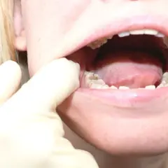 Ból zęba mądrości (ósemki): Szybka ulga i kiedy do dentysty?