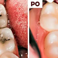 Domowe sposoby na próchnicę: co działa, a kiedy musisz iść do dentysty?