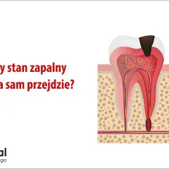 Stan zapalny zęba: Objawy, leczenie, koszty. Czy da się go uniknąć?