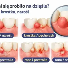 Guzek, krostka, przetoka na dziąśle – objawy mogą być różne, ale często towarzyszy im ćmiący ból zęba. Ilustracja pokazuje zmiany przy zębach.