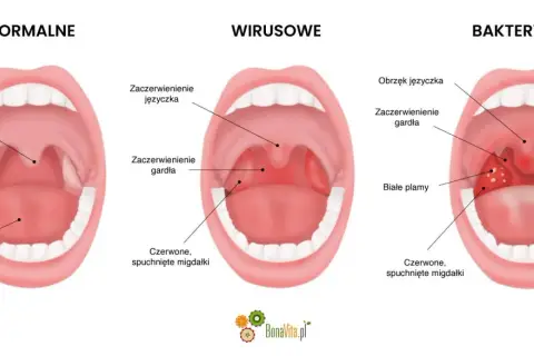 Porównanie gardła: normalne, wirusowe (zaczerwienienie, obrzęk języczka) i bakteryjne (białe plamy, afta w gardle).