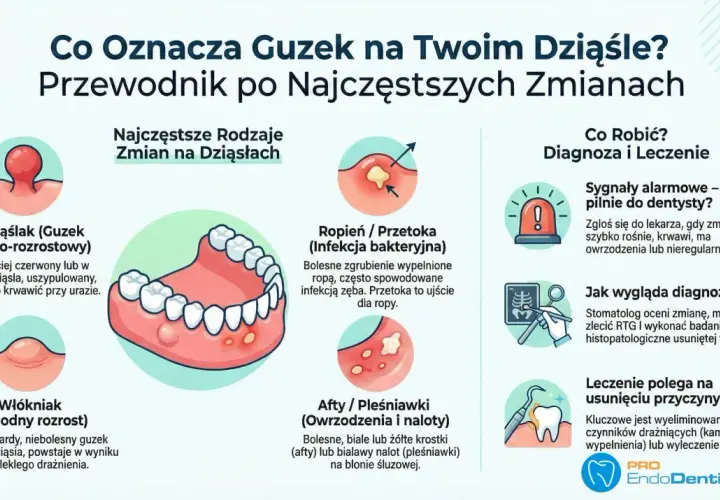 Nadziąślak to guzek zapalno-rozrostowy na dziąśle, często czerwony, który może krwawić.