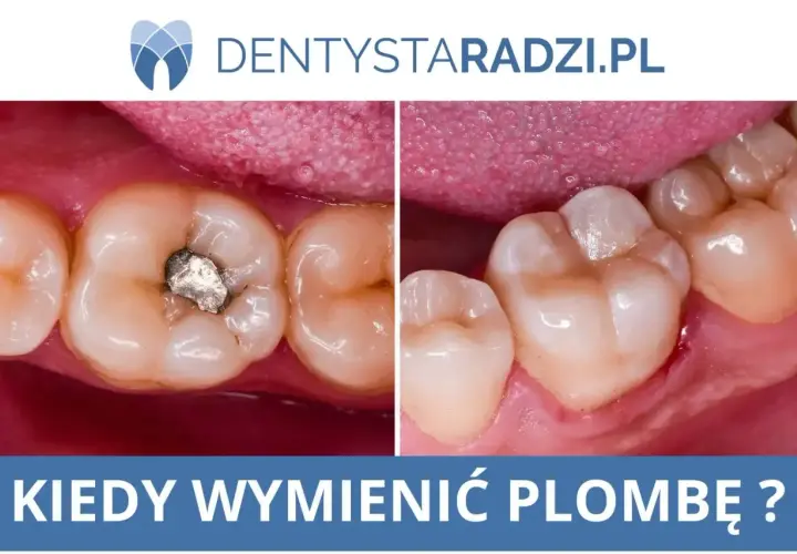 Porównanie zęba z amalgamatową plombą i zęba po wymianie na nową, estetyczną. Kiedy wymienić starą plombę?