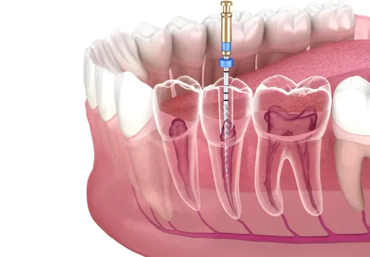 Jak bezpiecznie usunąć ząb? Kiedy dentysta, a kiedy domowe sposoby?