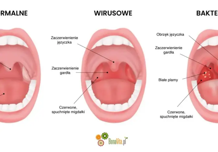 Porównanie gardła: normalne, wirusowe (zaczerwienienie, obrzęk języczka) i bakteryjne (białe plamy, afta w gardle).