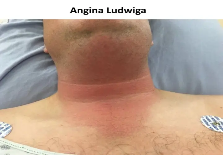 Szyja i klatka piersiowa pacjenta z widocznym zaczerwienieniem i obrzękiem, objawy wskazujące na anginę Ludwiga.