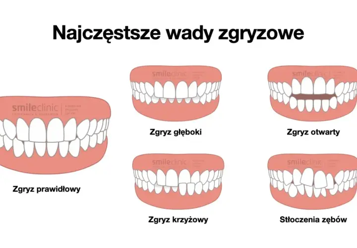 Ilustracja pokazuje różne wady zgryzu, w tym zgryz głęboki, otwarty, krzyżowy i stłoczenia zębów. Wady te mogą dotyczyć również tyłozgryzu u dziecka.