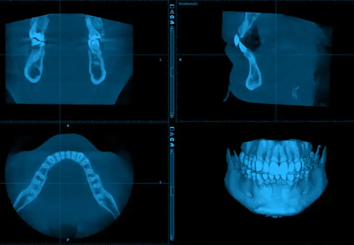 CBCT co to? Obraz pokazuje trójwymiarowe skanowanie szczęki i żuchwy, ukazujące zęby i kości w przekrojach.