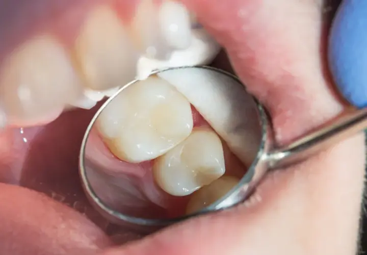 Stomatolog bada zęby, szukając próchnicy ukrytej. Widać fragment jamy ustnej, zęby i lusterko dentystyczne.