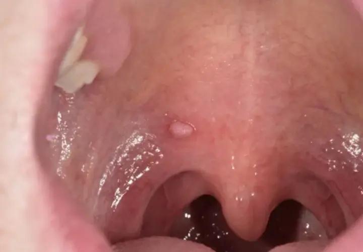 Objawy HPV w jamie ustnej: ciche sygnały, które ratują życie