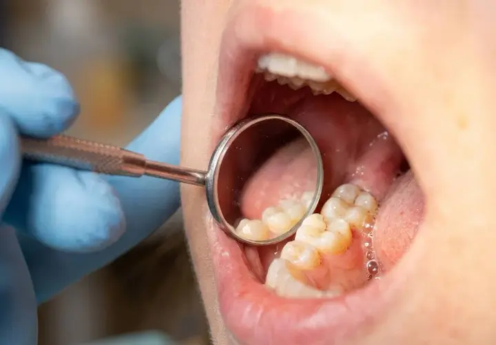 Dentysta bada zęby, szukając oznak infiltracji próchnicy. Widoczne są zęby i lusterko dentystyczne.