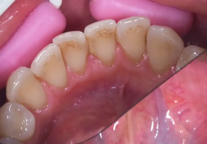Widok jamy ustnej z widocznymi przebarwieniami na zębach, każdy brązowy ząb wymaga uwagi.