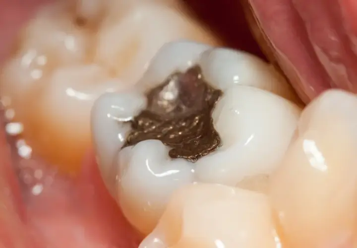 Widok zęba z widoczną, ciemną, metaliczną plombą, otoczoną białymi zębami i różowymi tkankami jamy ustnej.