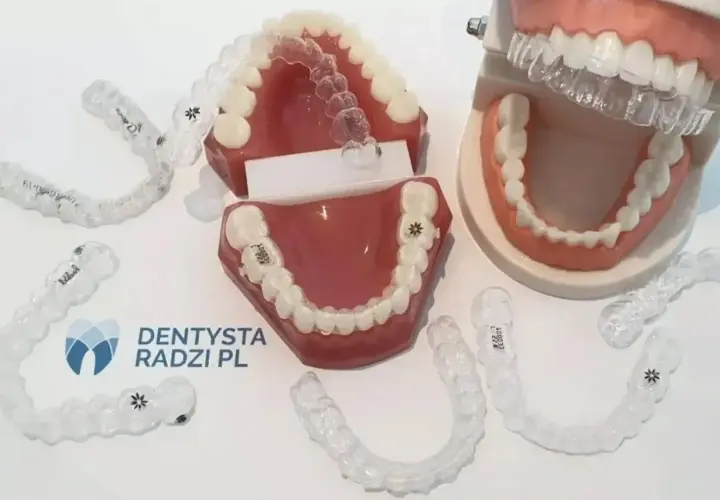 Modele szczęk z nakładkami ortodontycznymi. Zastanawiasz się, po jakim czasie widać pierwsze efekty aparatu ortodontycznego?