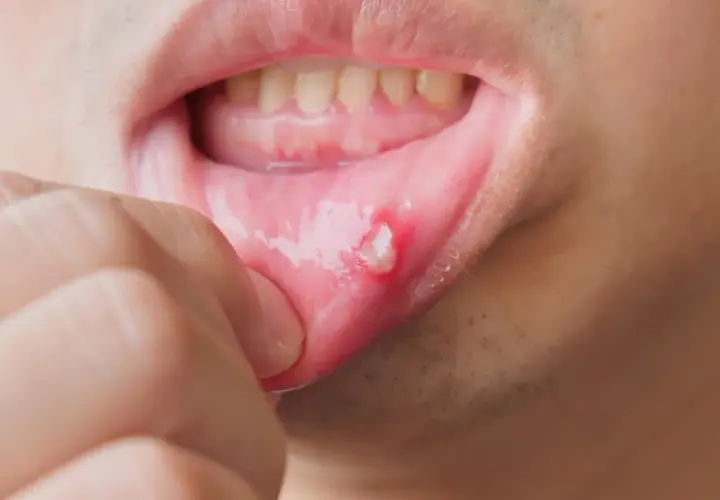 Masz opryszczkę? Dentysta odmówi! Co robić i kiedy iść?