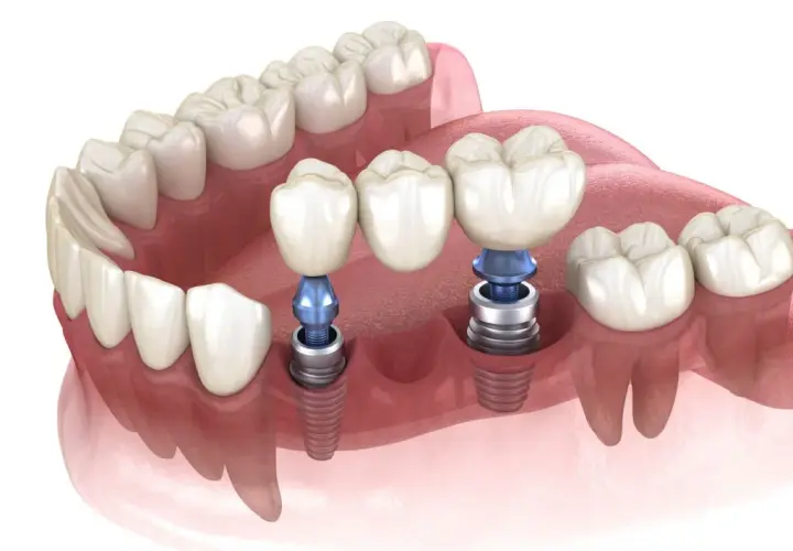 Koszt implantu zęba w Polsce: Pełna cena i co wpływa na nią?