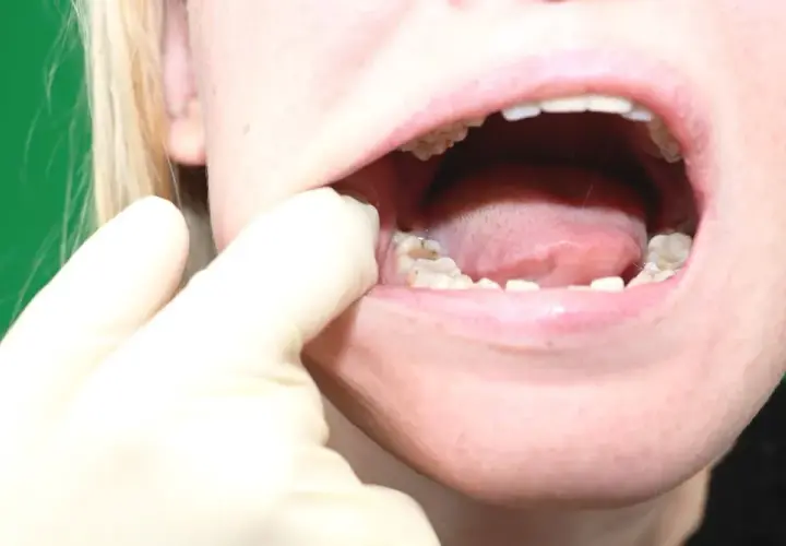 Ból zęba mądrości (ósemki): Szybka ulga i kiedy do dentysty?