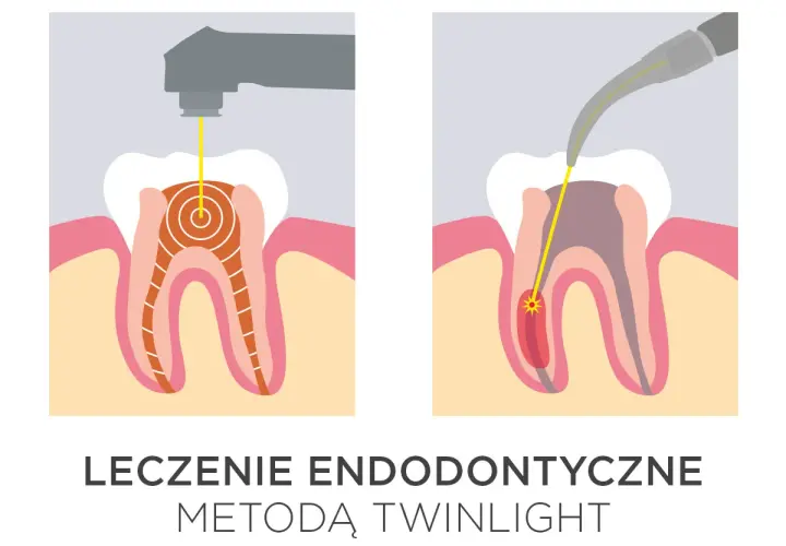 Ilustracja pokazuje laserowe leczenie zębów. Dwa etapy endodoncji z użyciem lasera, który precyzyjnie dociera do wnętrza zęba.