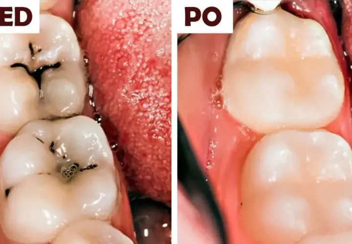 Domowe sposoby na próchnicę: co działa, a kiedy musisz iść do dentysty?