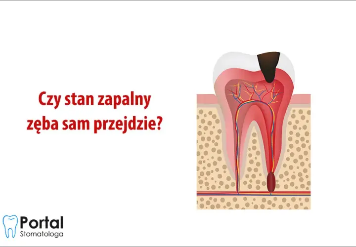 Stan zapalny zęba: Objawy, leczenie, koszty. Czy da się go uniknąć?
