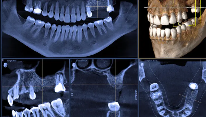 Tomografia CBCT prezentuje obraz zębów i szczęki w przekrojach: panoramicznym, osiowym, strzałkowym i poprzecznym.