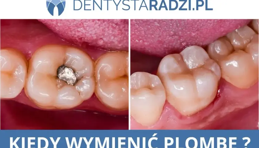 Porównanie zęba z amalgamatową plombą i zęba po wymianie na nową, estetyczną. Kiedy wymienić starą plombę?