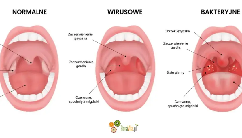 Porównanie gardła: normalne, wirusowe (zaczerwienienie, obrzęk języczka) i bakteryjne (białe plamy, afta w gardle).