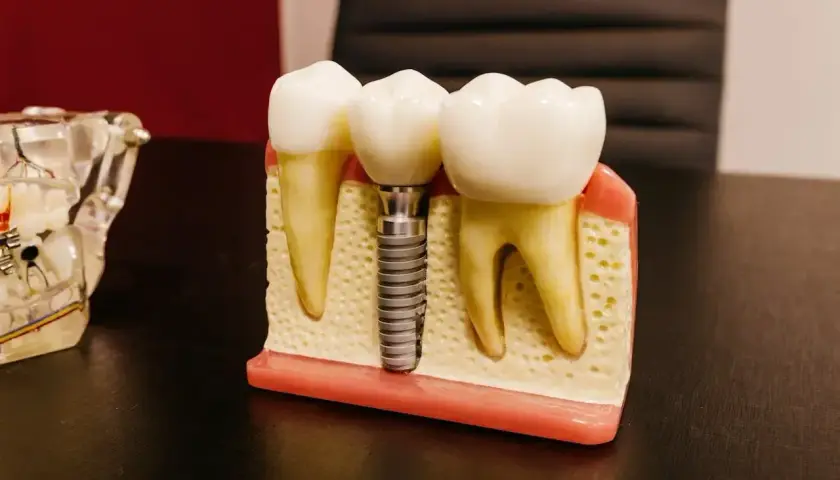 Model szczęki z zębami i mikroimplantem ortodontycznym. Pokazuje, jak implant zastępuje korzeń zęba.