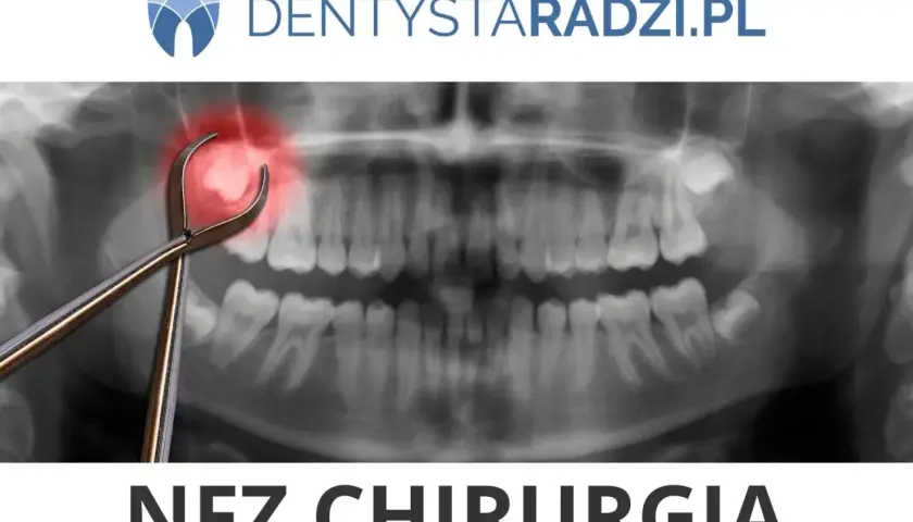 Rentgen zęba z kleszczami i czerwoną plamą bólu. Dowiedz się, ile kosztuje wyrwanie zęba w NFZ Chirurgia.