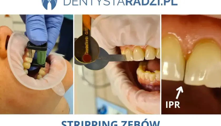 Zabieg stripping zębów: stomatolog używa narzędzi do delikatnego modelowania przestrzeni międzyzębowych (IPR).