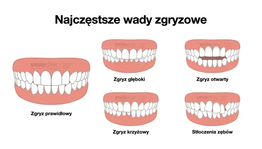 Ilustracja pokazuje różne wady zgryzu, w tym zgryz głęboki, otwarty, krzyżowy i stłoczenia zębów. Wady te mogą dotyczyć również tyłozgryzu u dziecka.